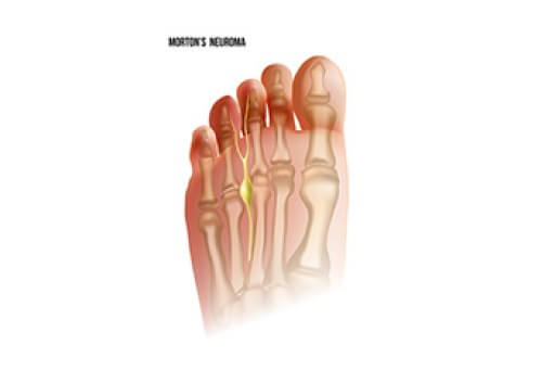 Morton's Neuroma