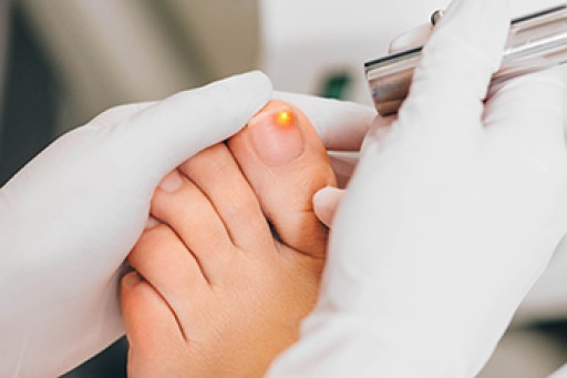 Laser Treatment for Fungal Nails