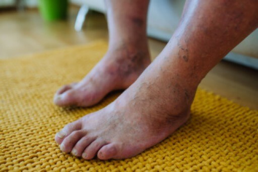 Diabetic Foot Care