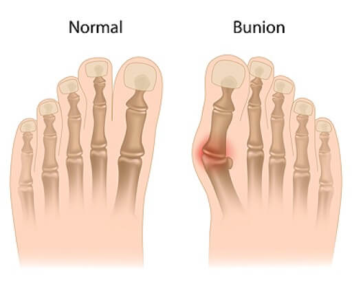 What Are Bunions?