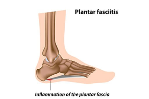 Plantar Fasciitis