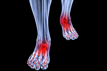 arthritic foot care in the Plymouth County, MA: Plymouth (Kingston, Duxbury, Marshfield, Pembroke, Hanson, Halifax, Middleborough, Carver, Bridgewater, Lakeville) areas