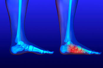 flat feet treatment in the Plymouth County, MA: Plymouth (Kingston, Duxbury, Marshfield, Pembroke, Hanson, Halifax, Middleborough, Carver, Bridgewater, Lakeville) areas