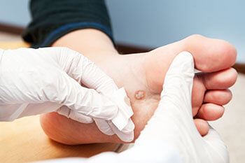 plantar warts treatment in the Plymouth County, MA: Plymouth (Kingston, Duxbury, Marshfield, Pembroke, Hanson, Halifax, Middleborough, Carver, Bridgewater, Lakeville) areas